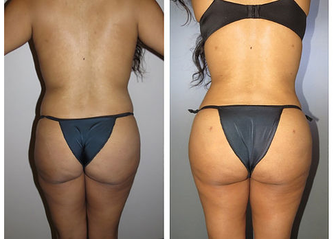 NYC Brazilian Butt Lift - Selfie Plastic Surgery Brazilian Wax Before And A...